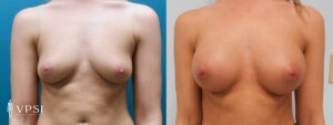 Vegas Before & After Breast Augmentation Patient 2a-1
