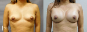 Vegas Before & After Breast Augmentation Patient 3a-1
