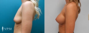 Vegas Before & After Breast Augmentation Patient 3b-1
