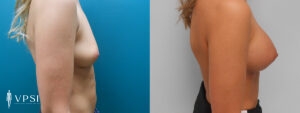 Vegas Before & After Breast Augmentation Patient 3c-1