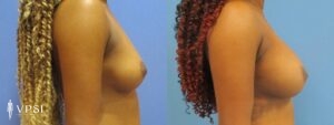 VPSI Before & After Breast Augmentation Patient 1b