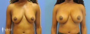 VPSI Before & After Breast Augmentation Patient 1c