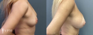 VPSI Before & After Breast Augmentation Patient 2a