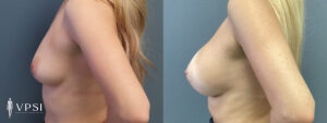 VPSI Before & After Breast Augmentation Patient 2b