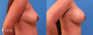 VPSI Before & After Breast Augmentation Patient 3a