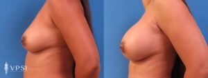 VPSI Before & After Breast Augmentation Patient 3b