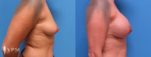VPSI Before & After Breast Augmentation Patient 4a