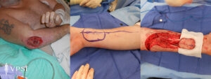 VPSI Before & After Elbow Wound Patient 1a
