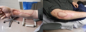 VPSI Before & After Elbow Wound Patient 1b