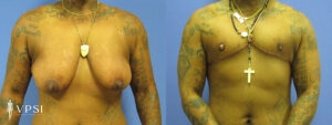VPSI Before & After Female to Male Patient 1c3