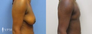 VPSI Before & After Female to Male Patient 4b