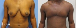 VPSI Before & After Female to Male Patient 4c