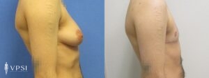 VPSI Before & After Female to Male Patient 5b