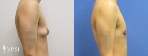 VPSI Before & After Female to Male Patient 7b