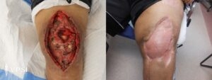 VPSI Before & After Knee Wound Patient 1a