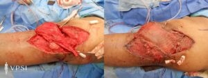 VPSI Before & After Knee Wound Patient 1b