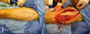 VPSI Before & After Lower Extremities Patient 1b