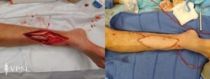 VPSI Before & After Lower Extremities Patient 2a