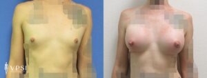 VPSI Before & Afters Male To Female Patient 2c