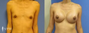 VPSI Before & Afters Male To Female Patient 3c