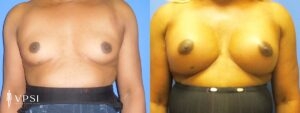 VPSI Before & Afters Male To Female Patient 4c