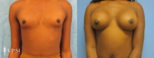 VPSI Before & Afters Male To Female Patient 7b