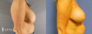 VPSI Before & After Revision Augmentation Mastopexy Patient 1b