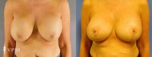 VPSI Before & After Revision Augmentation Mastopexy Patient 1c