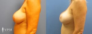 VPSI Before & After Revision Augmentation Mastopexy Patient 2a