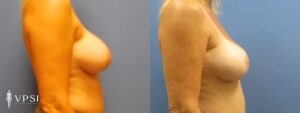 VPSI Before & After Revision Augmentation Mastopexy Patient 2b