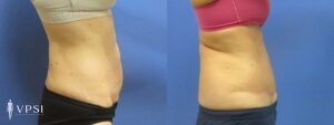 VPSI Before & After Tummy Tuck Patient 1a