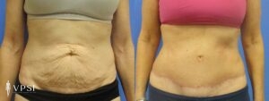 VPSI Before & After Tummy Tuck Patient 1b