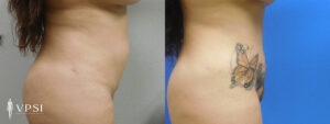 VPSI Before & After Tummy Tuck Patient 2a