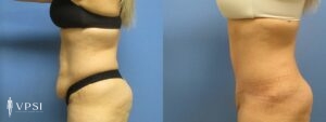 VPSI Before & After Tummy Tuck Patient 3a