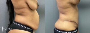 VPSI Before & After Tummy Tuck Patient 4a