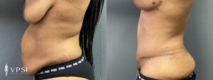 VPSI Before & After Tummy Tuck Patient 4b