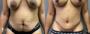 VPSI Before & After Tummy Tuck Patient 4c