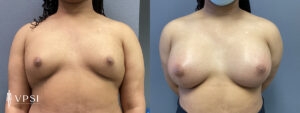 VPSI Before & Afters Male To Female Top Surgery Patient 1a