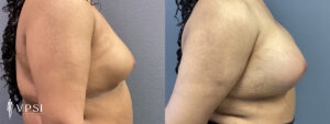 VPSI Before & Afters Male To Female Top Surgery Patient 1b