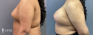 VPSI Before & Afters Male To Female Top Surgery Patient 1c