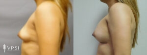 VPSI Before & After Breast Augmentation Patient 3c