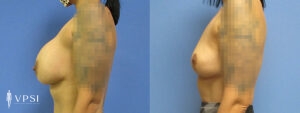 VPSI Before & After Breast Lift Patient 1a
