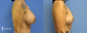 VPSI Before & After Breast Lift Patient 1b