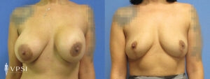 VPSI Before & After Breast Lift Patient 1c