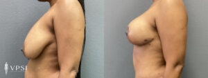 VPSI Before & After Breast Lift Patient 2b