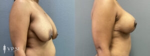 VPSI Before & After Breast Lift Patient 2c