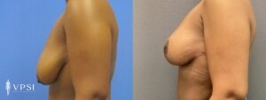 VPSI Before & After Mastopexy Patient 1a