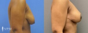 VPSI Before & After Mastopexy Patient 1b