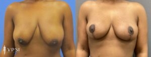 VPSI Before & After Mastopexy Patient 1c