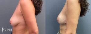 VPSI Before & After Mastopexy Patient 2b